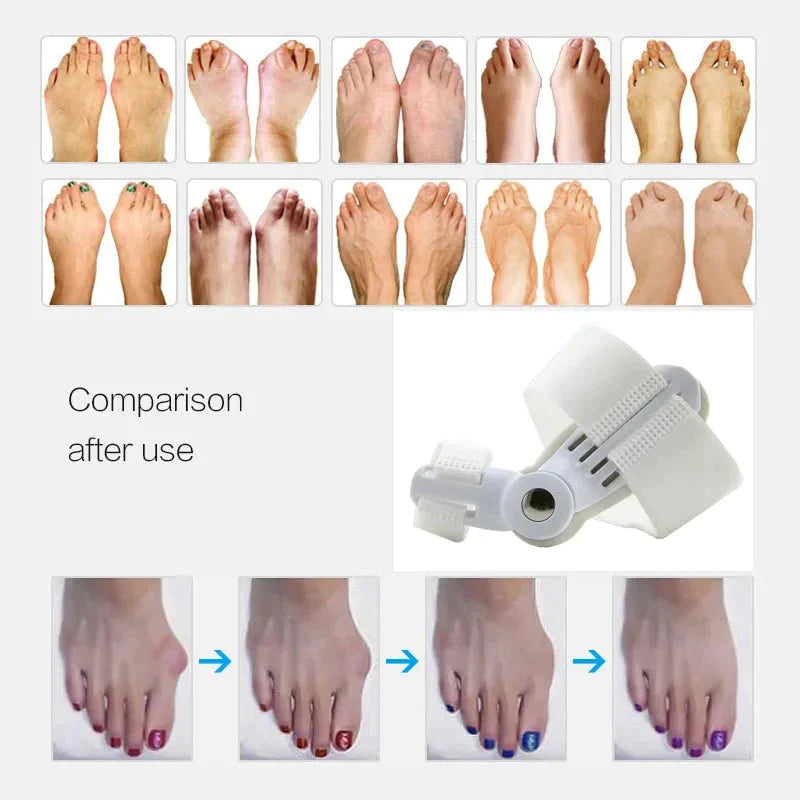 (1+1 FREE) Bunion Relief Splint - beumoonshop